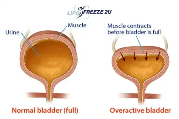 diagram of overactive bladder treatment Dorset