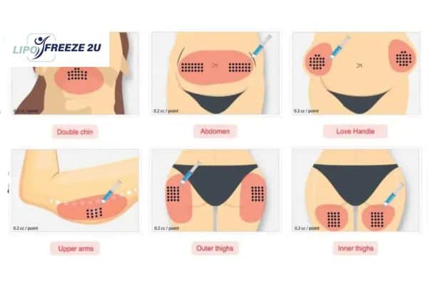 Benefits of Choosing Aqualyx for Fat Reduction Dorset