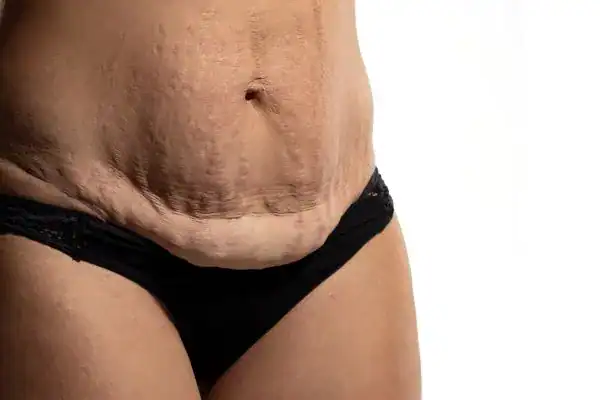loose skin after weight loss injections Dorset