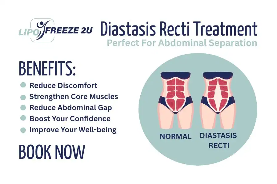 Benefits of body toning treatment Dorset for Diastasis recti