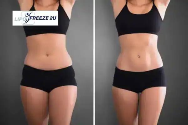 How Can LIPO FREEZE 2U Support Your Post-Pregnancy Body Recovery Dorset?