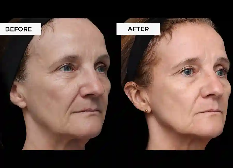 How Many RF Microneedling Sessions Will You Need to See a Difference Dorset?