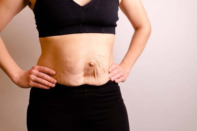 Is Surgery Really the Only Way to Repair Diastasis Recti Dorset?