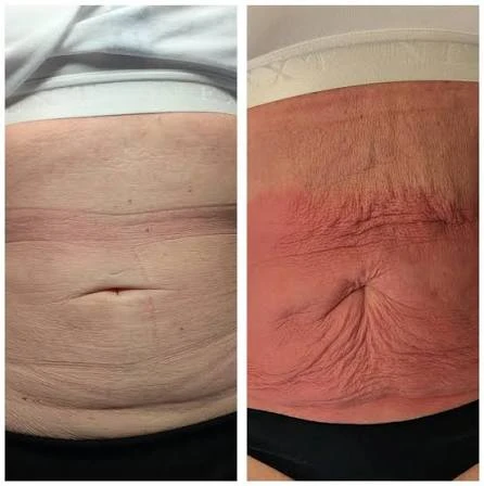 How Does RF Microneedling Improve Crepey, Thin and Uneven Skin Texture Dorset?