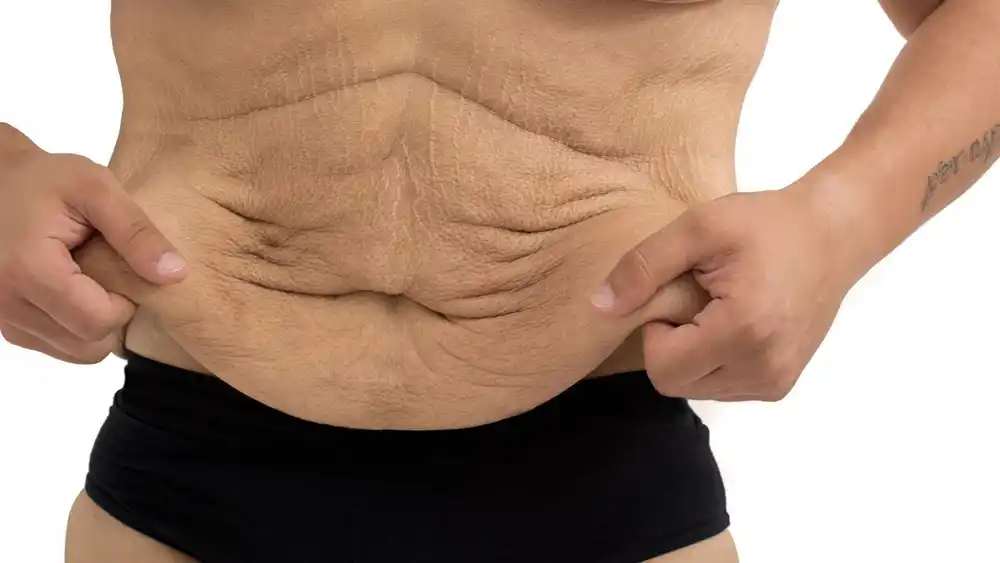 Why Does Weight Loss Medication Leave Some People With Loose or Sagging Skin Dorset?